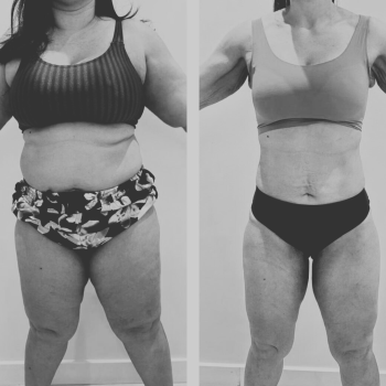 Antes x Depois - Dr. Bruno 3