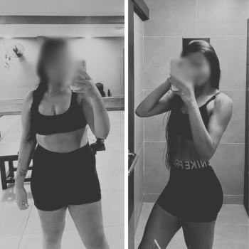 Antes x Depois - Dr. Bruno 4